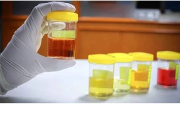 இது ரொம்ப danger.. சிறுநீரின் நிறம் இப்படி மாறினால் புற்று நோயின் அறிகுறி!