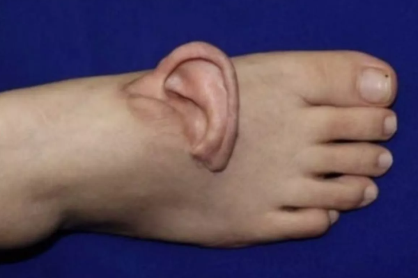 இளம்பெண்ணின் காதை காலுடன் இணைத்து தைத்த மருத்துவர்கள்: ஒரு சுவாரஸ்ய செய்தி | Women Ear Torn Off In Accident Attached In Foot இளம்பெண்ணின் காதை காலுடன் இணைத்து தைத்த மருத்துவர்கள்: ஒரு சுவாரஸ்ய செய்தி | Women Ear Torn Off In Accident Attached In Foot