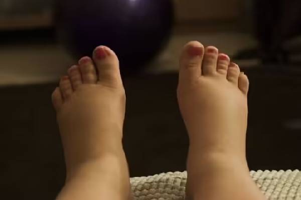elephantiasis symptoms: யானைக்கால் நோய்... தொற்று நோயா? அறிகுறிகள் எப்படியிருக்கும்? | Elephantiasis Symptoms In Tamil