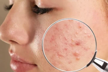 முகப்பருக்கள் நிரந்தரமாக நீங்க வேண்டுமா? இந்த 4 உணவுகளை தவிர்த்து விடுங்கள்