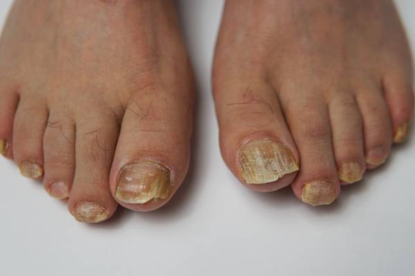 நகம் நொருங்குதா? அப்போ இந்த நோய் உங்களுக்கு இருக்கலாம் | Causes Of Brittle Nails