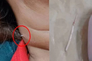 கழுத்தை கிழித்து தோளுக்கு மேல் வந்த மீன் முள் - சூப் குடித்தபோது தொண்டையில் விபரீதம்