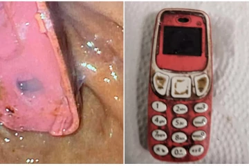 செல்போனை விழுங்கிய நபர் - அறுவை சிகிச்சை மூலம் அகற்றிய மருத்துவர்கள்