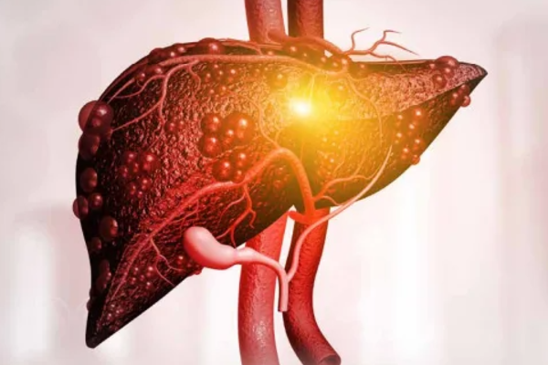 கல்லீரல் நோய் இருப்பதை எச்சரிக்கும் 6 அறிகுறிகள்.., என்னென்ன தெரியுமா? | 6 Warning Signs Of Liver Disease In Tamil கல்லீரல் நோய் இருப்பதை எச்சரிக்கும் 6 அறிகுறிகள்.., என்னென்ன தெரியுமா? | 6 Warning Signs Of Liver Disease In Tamil