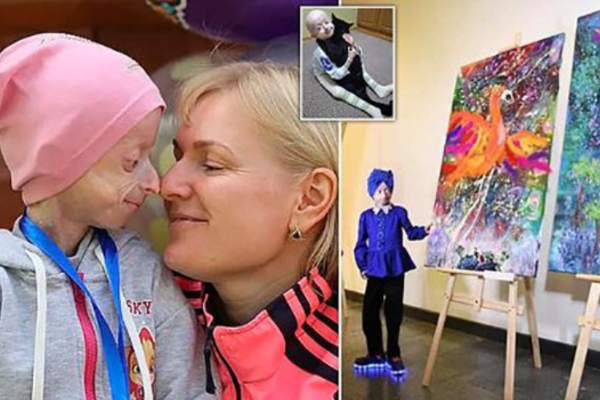 10 வயதில் 80 வயது தோற்றம் - அரியவகை நோயால் பாதிக்க சிறுமி மரணம்! | World