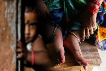 யானைக்கால் நோயினால் அச்சுறுத்தலுக்குள்ளாகும் குழந்தைகள் : சுகாதார திணைக்களம் விடுத்துள்ள அறிவித்தல்