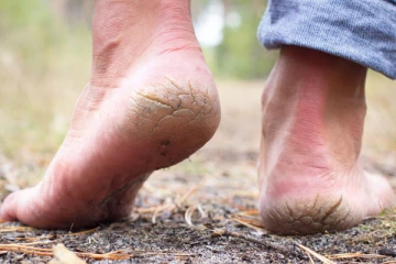 பாத வெடிப்பு உங்களை பாடாய்படுத்துகிறதா? இதனை போக்க இதோ சில டிப்ஸ்