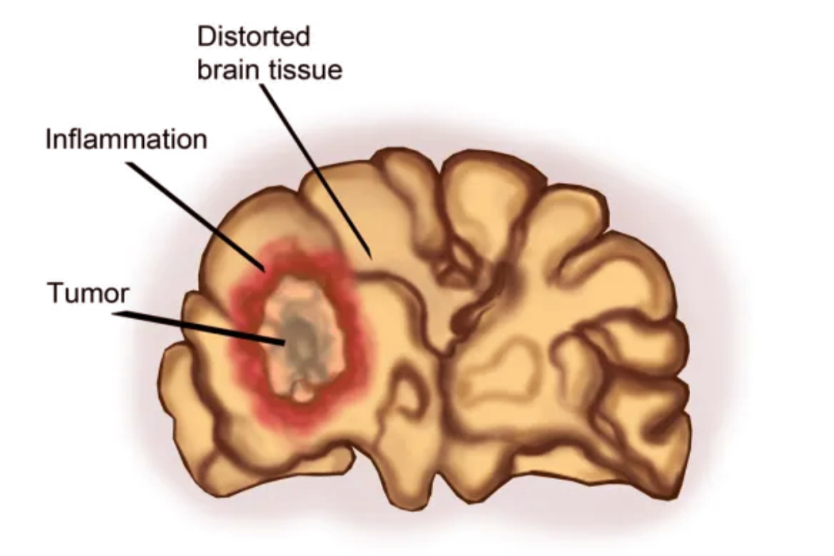 மூளைக்கட்டியின் ஆரம்ப அறிகுறிகள் என்ன? நிபுணர் விளக்கம் | Early Signs Of A Brain Tumor Expert Explanation மூளைக்கட்டியின் ஆரம்ப அறிகுறிகள் என்ன? நிபுணர் விளக்கம் | Early Signs Of A Brain Tumor Expert Explanation
