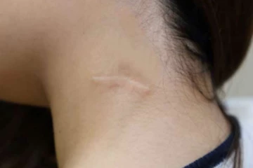 எவ்ளோ பெரிய தழும்பா இருந்தாலும் ஐந்து நிமிடங்கள் இதை போட்டா மறைஞ்சிடும்!