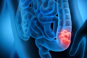 பெருங்குடல் புற்றுநோய் வர காரணம் என்ன? அறிகுறிகளும் தடுக்கும் வழிமுறைகளும்!