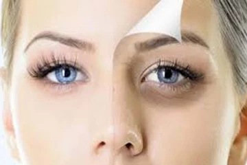 அழகை கெடுக்கும் கருவளையத்தால் கவலைப்படுறீங்களா? எளிய வீட்டு வைத்தியம் இதோ