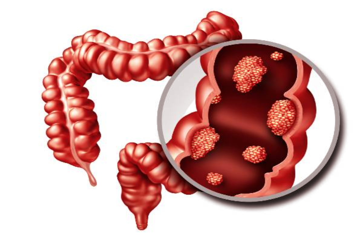 பெருங்குடல் புற்றுநோயின் அறிகுறிகள் என்னென்ன? | What Are The Symptoms Of Colon Cancer
