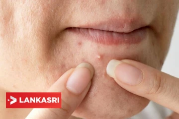 அதிகமா முகப்பரு வருதா? இதனை எளிய முறையில் போக்க இதோ சில அற்புத வழிகள்!