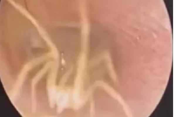 இளம்பெண்ணின் காதுக்குள் உயிருடன் வாழ்ந்த சிலந்தி பூச்சி: மருத்துவர்கள் கண்ட அதிர்ச்சி காட்சி | Doctor Finds Spider Living Inside Woman S Ear