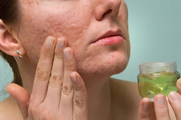 பருக்களால் ஏற்பட்ட வடுக்கள் மறைக்க வேண்டுமா? இதோ சூப்பர் டிப்ஸ்!