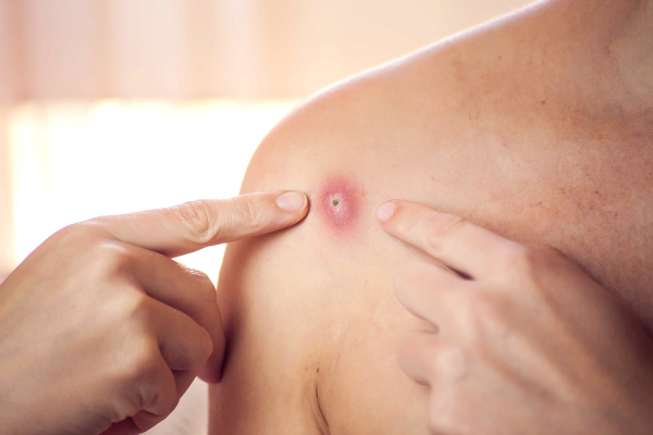 உயிரை பறிகும் அடுத்த ஆபத்து...குரங்கம்மையின் அறிகுறிகள் என்னென்ன தெரியுமா? | Symptoms Of Monkeypox Disease