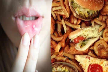 உங்களுக்கு அடிக்கடி வாய்ப்புண் வருகின்றதா? அப்போ இனி இந்த உணவுகளை குறைத்துக் கொள்ளுங்கள்