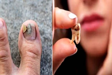 நகம், பல் சொத்தையாக மாறுதா? அப்போ இது தான் சரியான தீர்வு- செய்து பாருங்க!