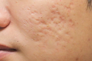 முகத்தில் அசிங்கமாக தெரியும் வடுக்களை எப்படி குணப்படுத்தலாம்?