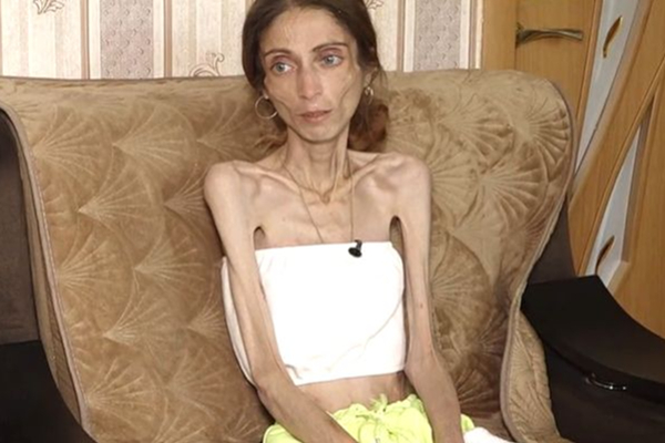 Chubby கன்னம் பிடிக்கல.. கணவனுக்காக பட்டினி கிடந்து மாறிய மனைவி - அதிரவைக்கும் சம்பவம் | Russia Woman Starves Herself To 22 Kg For Husband