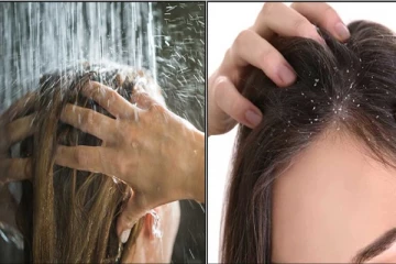 வெய்யில் காலத்தில் தலையில் ஏற்படும் பொடுகு! இதை மட்டும் செய்தாலே போதும் உடனடிபலன்