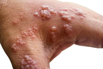 ஆட்டிப் படைக்கும் குரங்கு அம்மை! நோய் பாதித்தால் என்ன செய்ய வேண்டும்?