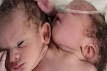 2 தலை, 3 கைகளுடன் பிறந்த அதிசயக் குழந்தை -  மருத்துவமனையில் தீவிர சிகிச்சை