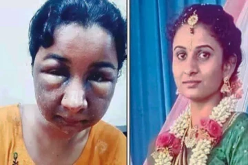 மேக்கப் போட்டதால் வந்த வினை - மணமகளுக்கு முகம் வீங்கியதால் திருமணத்தை நிறுத்திய மணமகன்