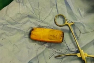 வயிற்றுக்குள் முழு செல்போன்: ஸ்கேனில் மருத்துவர்கள் கண்ட அதிர்ச்சி காட்சி