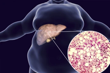 கல்லீரலில் உள்ள கொழுப்பை நீக்க வேண்டுமா? இதே சில எளிய வழிமுறைகள்