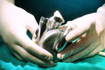 மரணத்தில் செயற்கை இதயம் பொருத்தி உயிர் கொடுத்த வைத்தியர்கள்