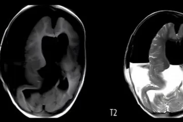 குழந்தையின் தலைக்குள் இருந்த அதன் இரட்டைக் குழந்தை: அதிர்ச்சியூட்டும் ஒரு சம்பவம்