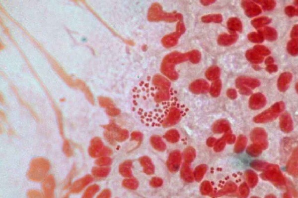 கனடாவில் ஆபத்தான பால்வினை நோய் தொடர்பில் எச்சரிக்கை | Resistant Gonorrhea On The Rise In Canada