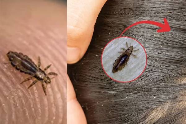 நம்ம தலையில் எப்படி பேன் வருதுன்னு தெரியுமா? வியக்க வைக்கும் உண்மைகள்! | Do You Know How Lice Get On Our Heads