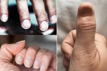 காரணம் இல்லாமல் நகம் வீக்கமா இருக்கா? புற்றுநோயாக இருக்கலாம்