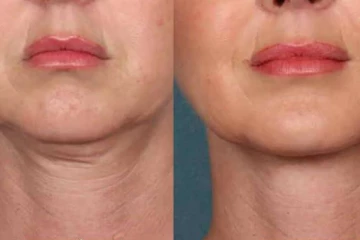 கழுத்துப் பகுதியில் அசிங்கமான சுருக்கங்கள் இருக்கா? ஒரே நாளில் மாயமாக்க சூப்பர் ஐடியா?