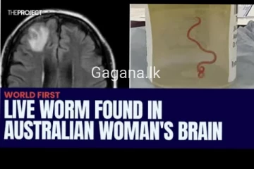 ලොව ප්‍රථම වරට කතකගේ මොළයෙන් සජීවී පණුවෙකු හමුවෙයි..ඔබටත් මෙවැනි රෝග ලක්ෂණ තියේද.(PHOTOS)
