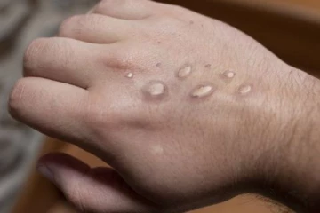 புதுக்கோட்டை மாவட்டத்தில் ஒருவருக்கு குரங்கு அம்மை?