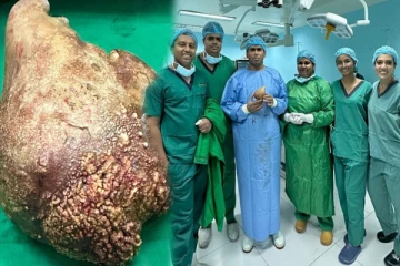 உலகில் மிகப்பெரிய சிறுநீரக கல்; கின்னஸ் உலக சாதனை