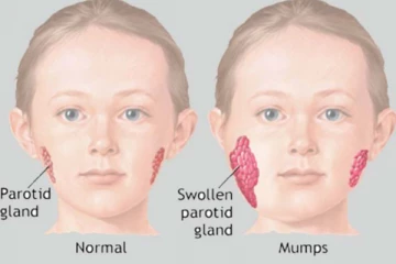 குழந்தைகளை அதிகமாக தாக்கும் பொன்னுக்கு வீங்கி! அறிகுறிகள் என்னென்ன?