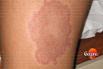 තවත් රෝගයක් ගැන හෙළිදරව්වක්