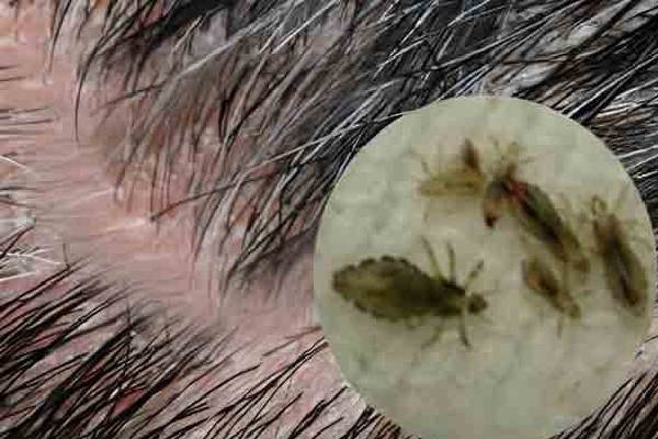 நம்ம தலையில் எப்படி பேன் வருதுன்னு தெரியுமா? வியக்க வைக்கும் உண்மைகள்! | Do You Know How Lice Get On Our Heads