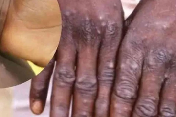ඉතාම සමීප ඇසුරකින් පමණයි මන්කිපොක්ස් (Monkeypox) ආසාදනය වන්නේ..