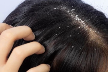 பொடுகு தொல்லையா? கவலை விடுங்க.. எளியமுறையில் போக்க இதோ அட்டகாசமான சில டிப்ஸ்