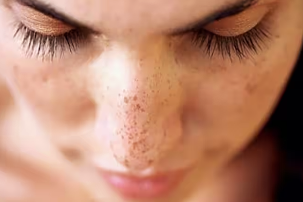 மூக்கைச் சுற்றியிருக்கும் பிடிவாதமான கரும்புள்ளி - 1நிமிடத்தில் போக இதை செய்ங்க | Remove Blackheads Accumulated Around Nose