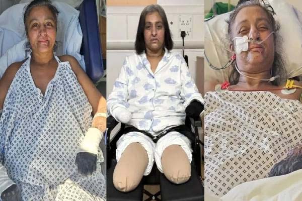 நாய் நக்கியதால் கை கால்களை இழந்த பெண் | Dog Licked Woman Loses Arm And Leg