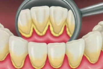 பற்கள் மஞ்சள் கரை போகவில்லையா? உடனே சரிசெய்ய எளிய வழிமுறை இதோ!..