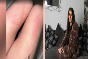 தண்ணீர் பட்டாலே அலர்ஜி... அரிய நோயால் பாதிக்கப்பட்ட 25 வயது பெண்!