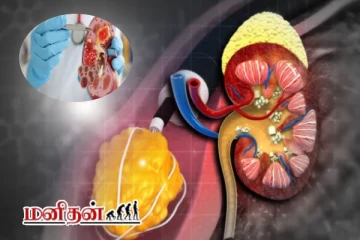 சிறுநீரக கல் பிரச்சனையால் பாதிக்கப்பட்டவரா நீங்கள்? அப்போ இதை சாப்பிட்டால் போதும்