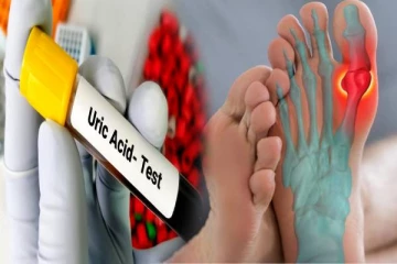 யூரிக் அமிலத்தை ஈஸியா கட்டுப்படுத்தனுமா? இந்த உணவுளுக்கு நோ சொல்லிருங்க